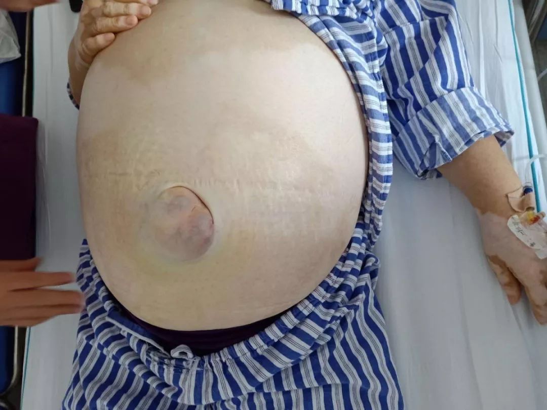 我院麻醉科为妇科成功切除患者巨大肿物保驾护航