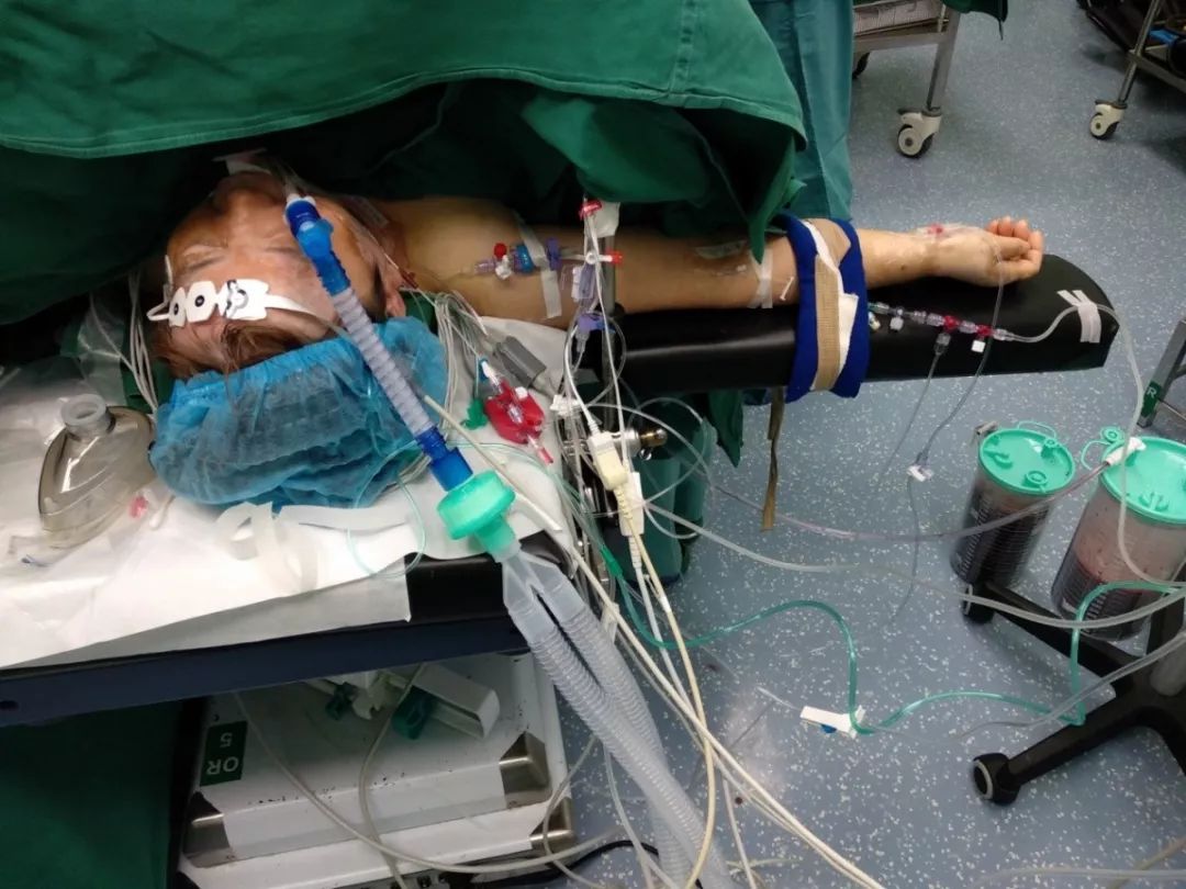 我院麻醉科为妇科成功切除患者巨大肿物保驾护航